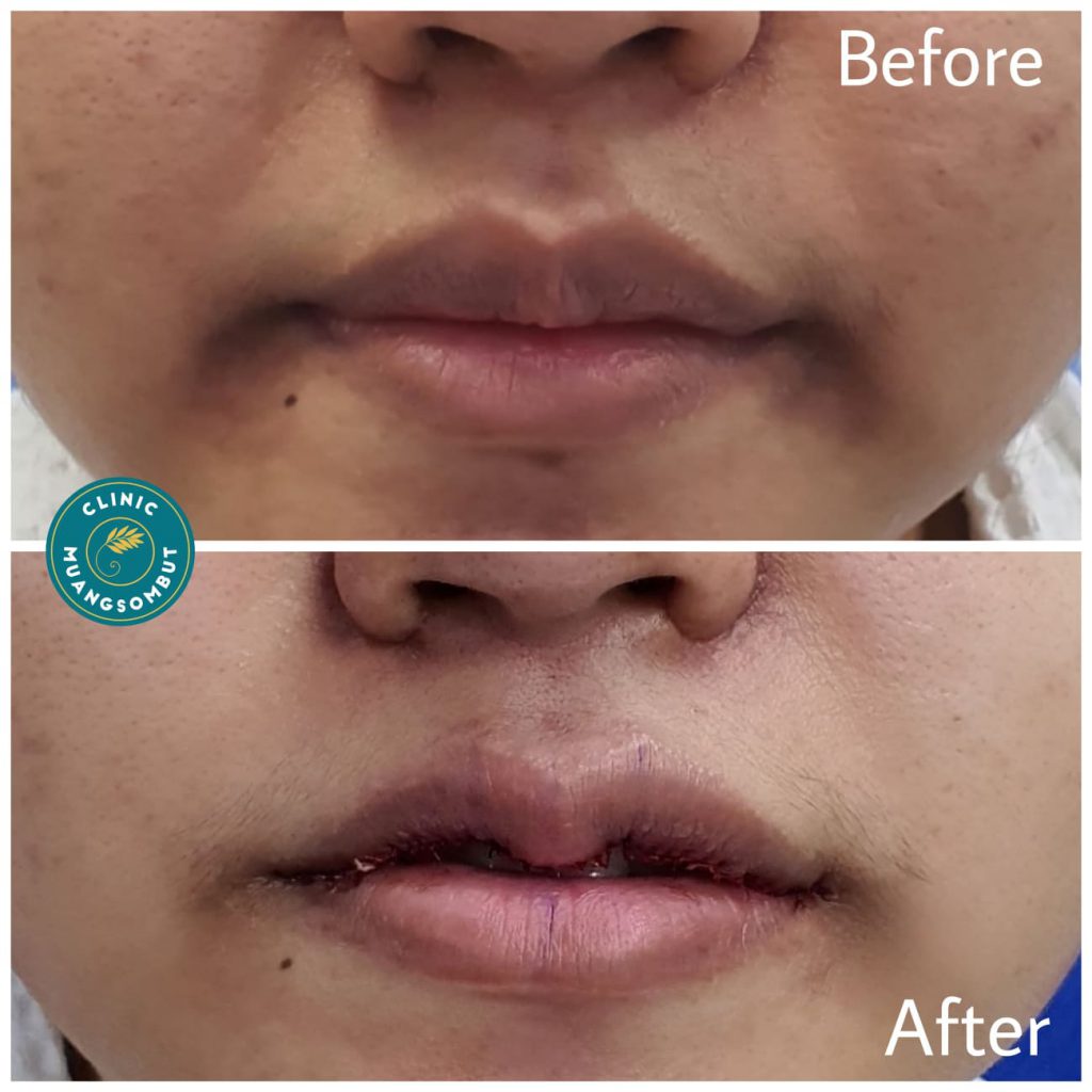 ทำปากกระจับหาดใหญ่