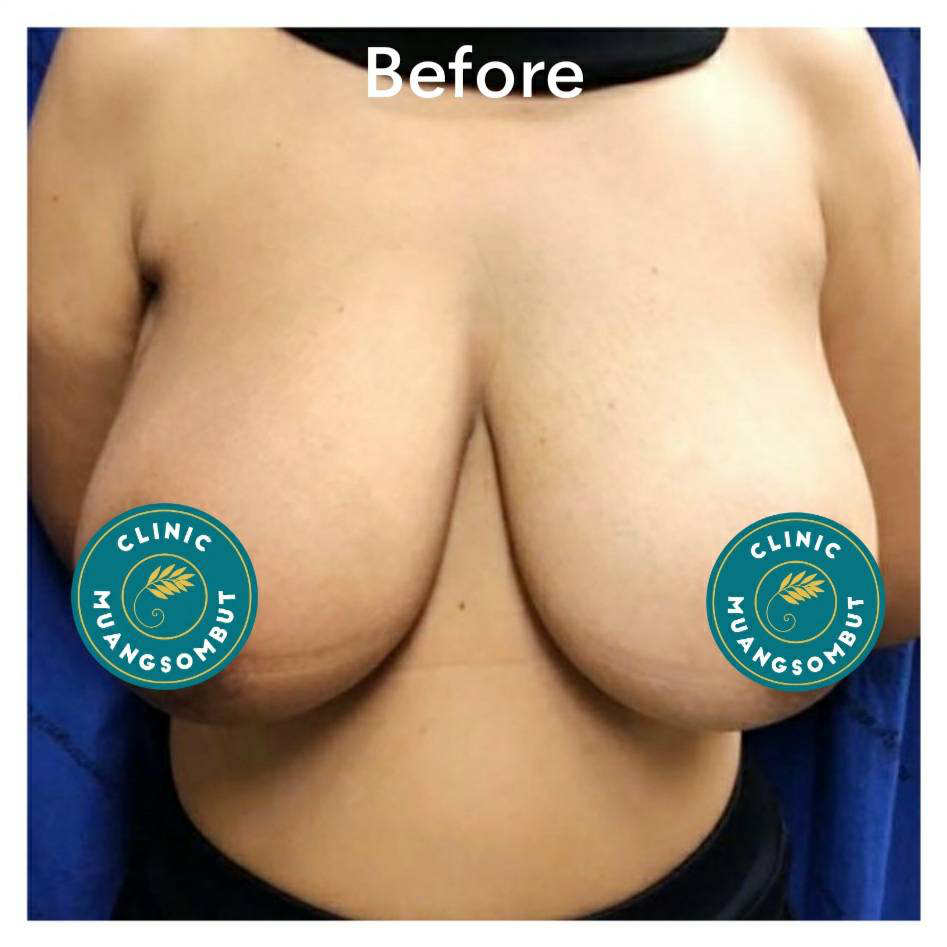 ลดขนาดหน้าอก