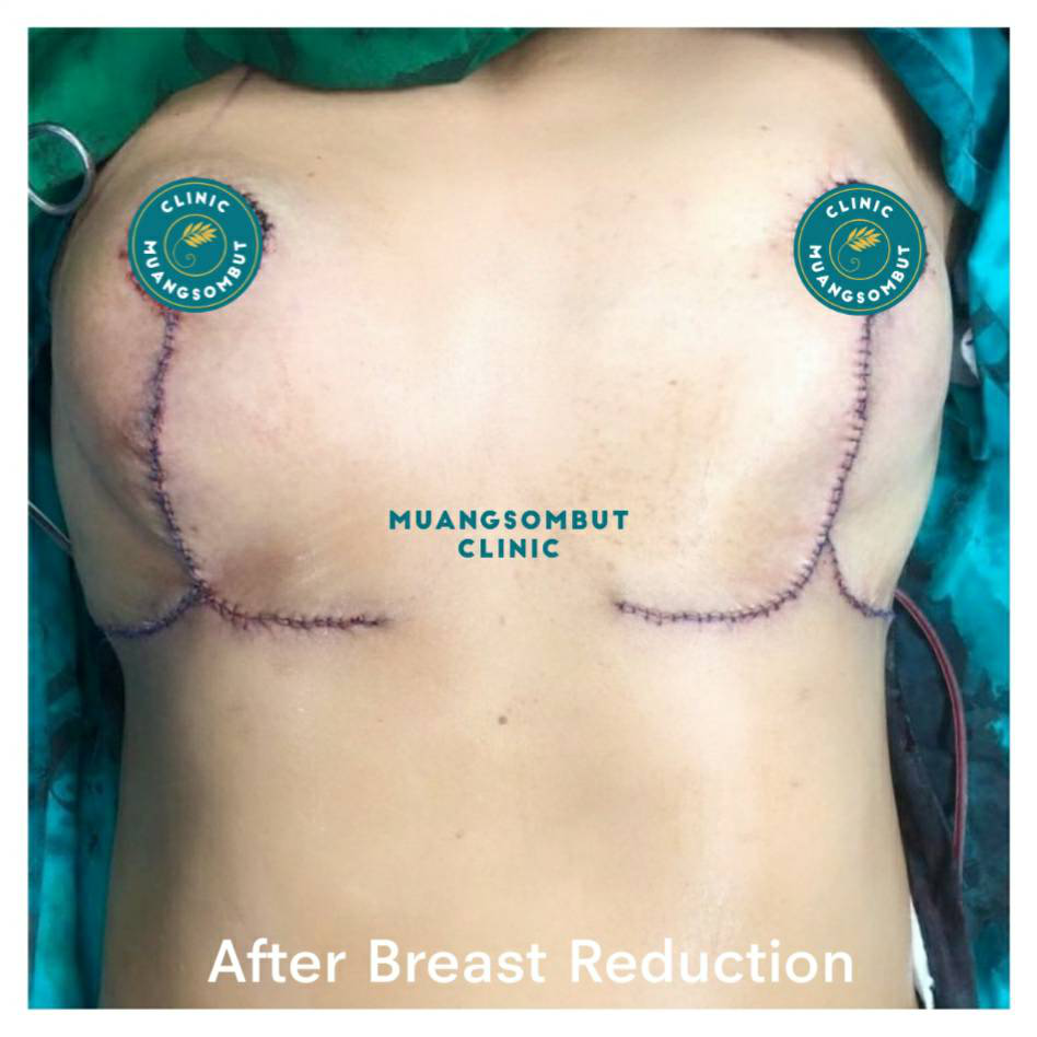 ลดขนาดหน้าอก